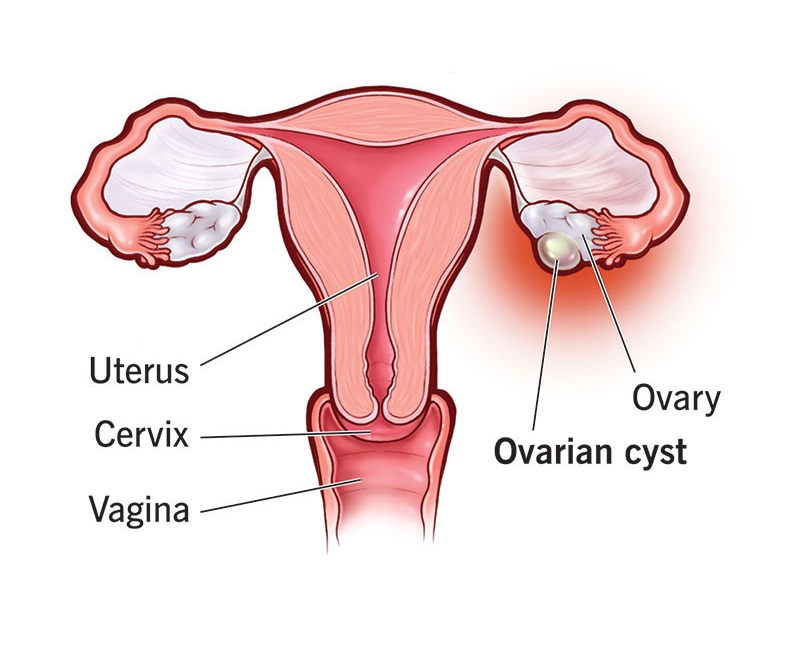 ovarian-cysts- Dr. Farzana Yeasmin Ety