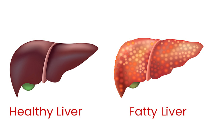 ফ্যাটি লিভার - Dr. Farzana Yeasmin Ety Fatty Liver-Dr Farzana Yeasmin Ety