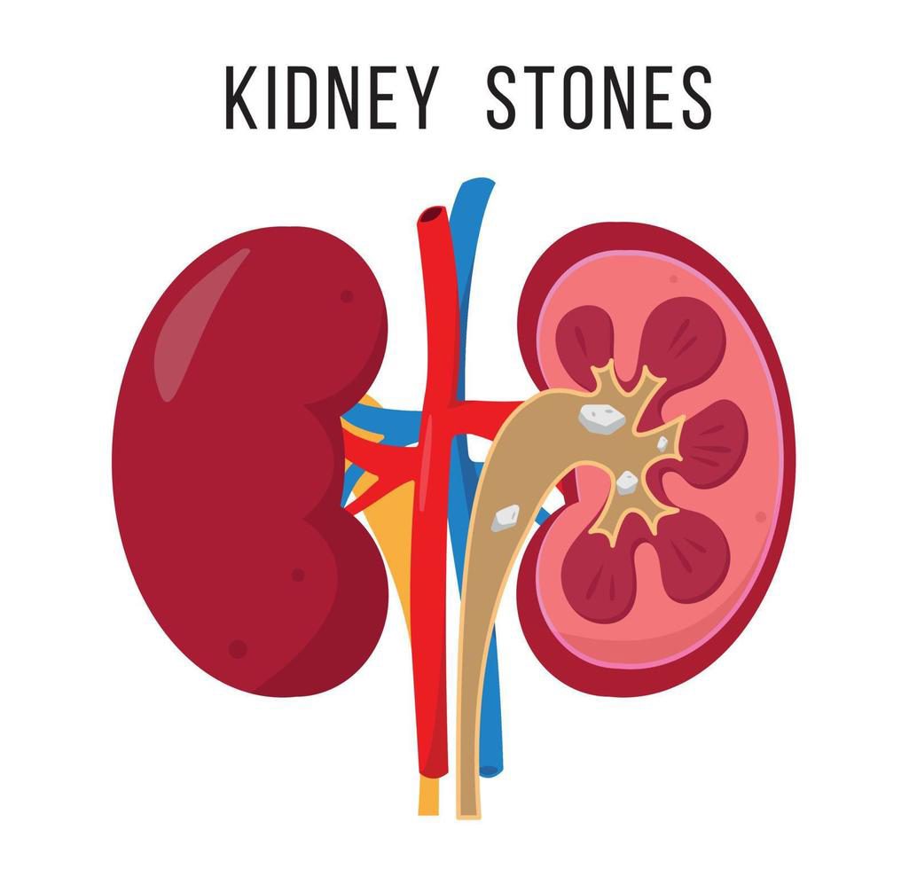 kidney-stone-Dr Farzana Yeasmin Ety